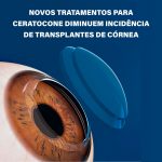 Tratamento para ceratocone apresenta avanços