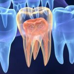 Endodontia ganha espaço na saúde pública nacional