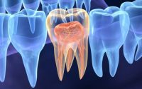 Endodontia ganha espaço na saúde pública nacional