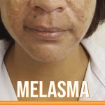 Melasma pode ser tratado com ativos específicos