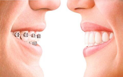 Bráquetes ou Invisalign