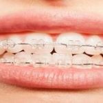 Bráquetes ou Invisalign: comparando as opções para alinhar os dentes Bráquetes ou Invisalign: comparando as opções para alinhar os dentes